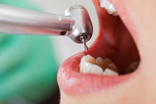 Best Emergency Treatment for Dental Infections or Abscesses in Lebanon, OR